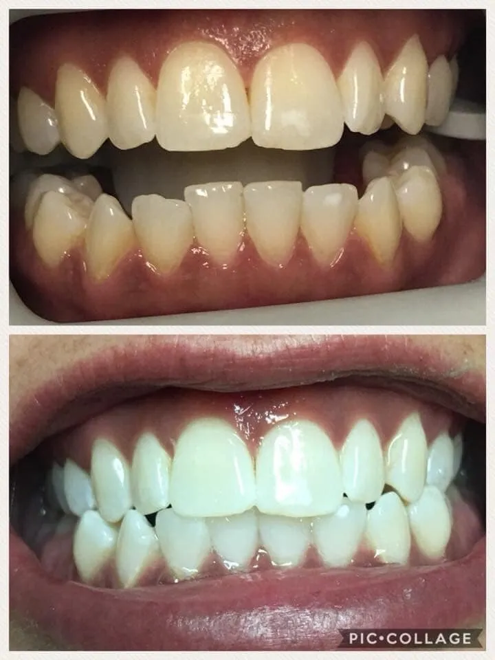 Zoom whitening before and after result 1