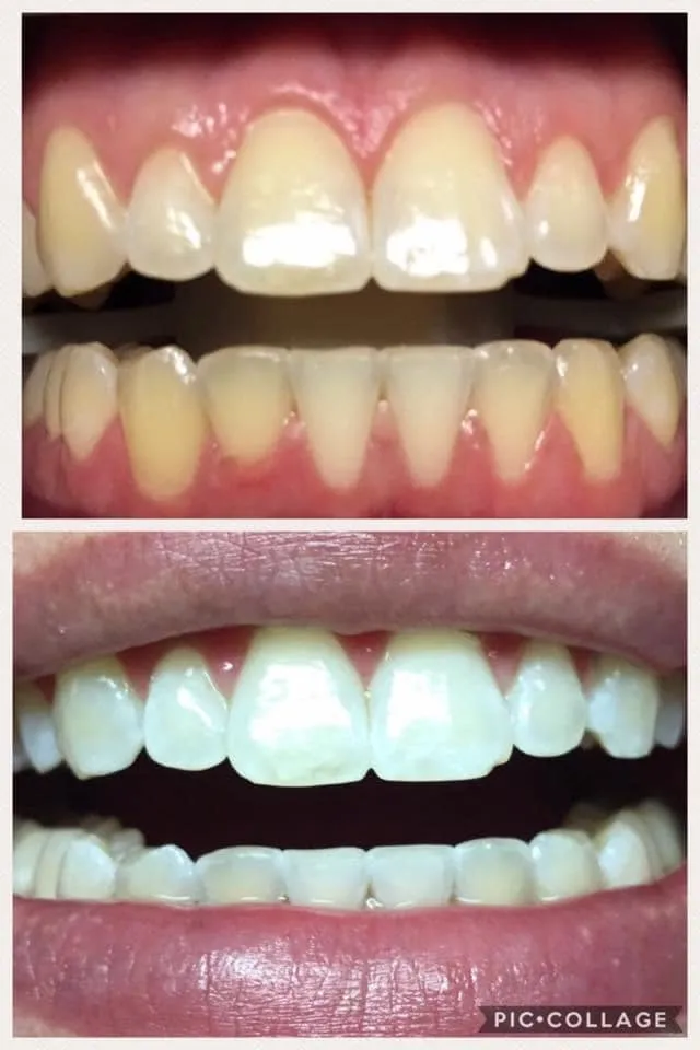 Zoom whitening before and after result 2