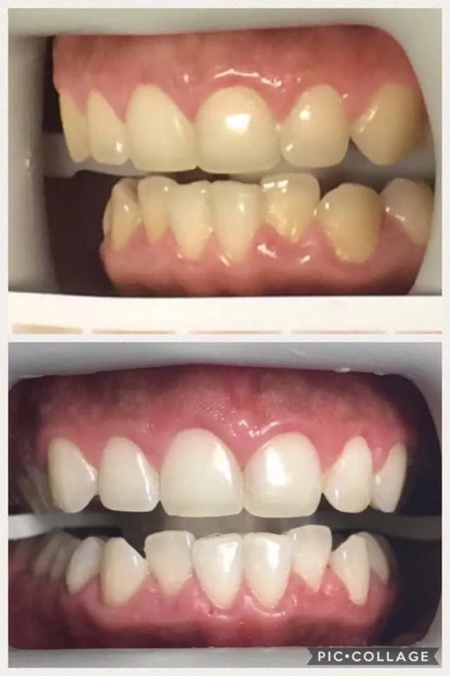 Zoom whitening before and after result 4
