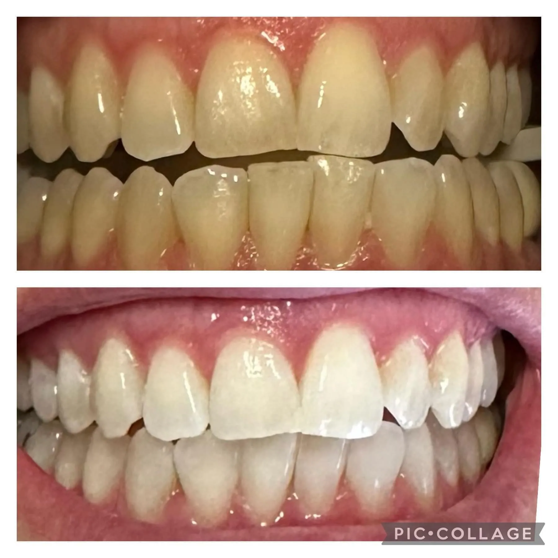 Zoom whitening before and after result 5