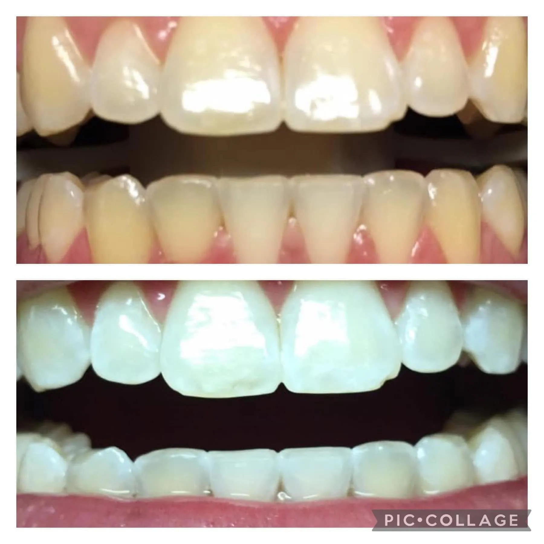 Zoom whitening before and after result 6